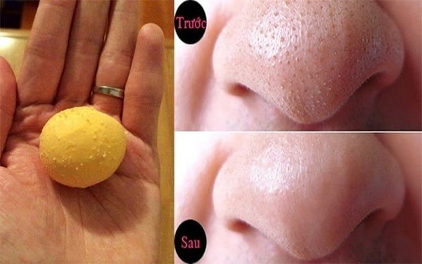 mun-dau-den-la-gi-nhung-cach-tri-mun-dau-den-hieu-qua-ban-nen-biet4