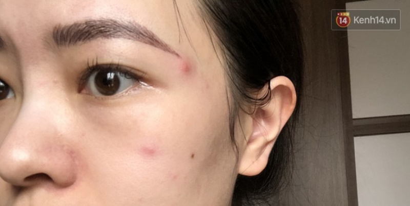 tam-su-cua-co-gai-theo-trend-khong-dung-sua-rua-mat-ket-qua-mun-moc-day-mat2