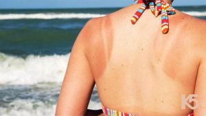 bi-quyet-cuu-canh-lan-da-chay-nang1