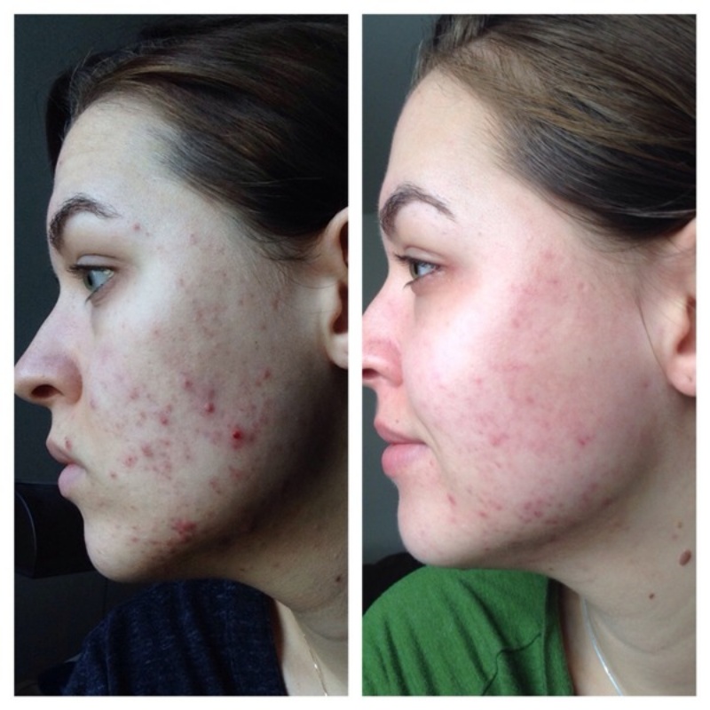 nhung-luu-y-nen-nho-khi-chon-tonner-cho-da-dau-mun6